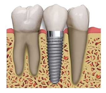 Dental Implants in Kanpur