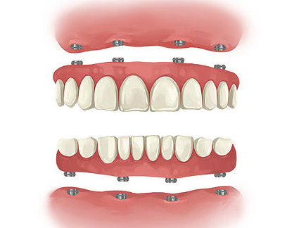 Full Mouth Dental Implants in Kanpur