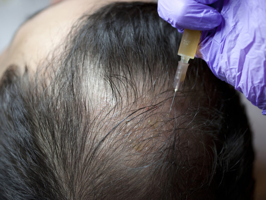 Hair Treatment in Kanpur