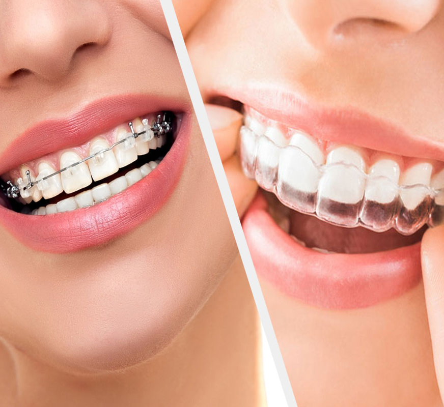 Invisible Braces in Kanpur