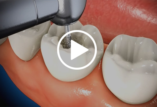 Root Canal Treatment in Kanpur