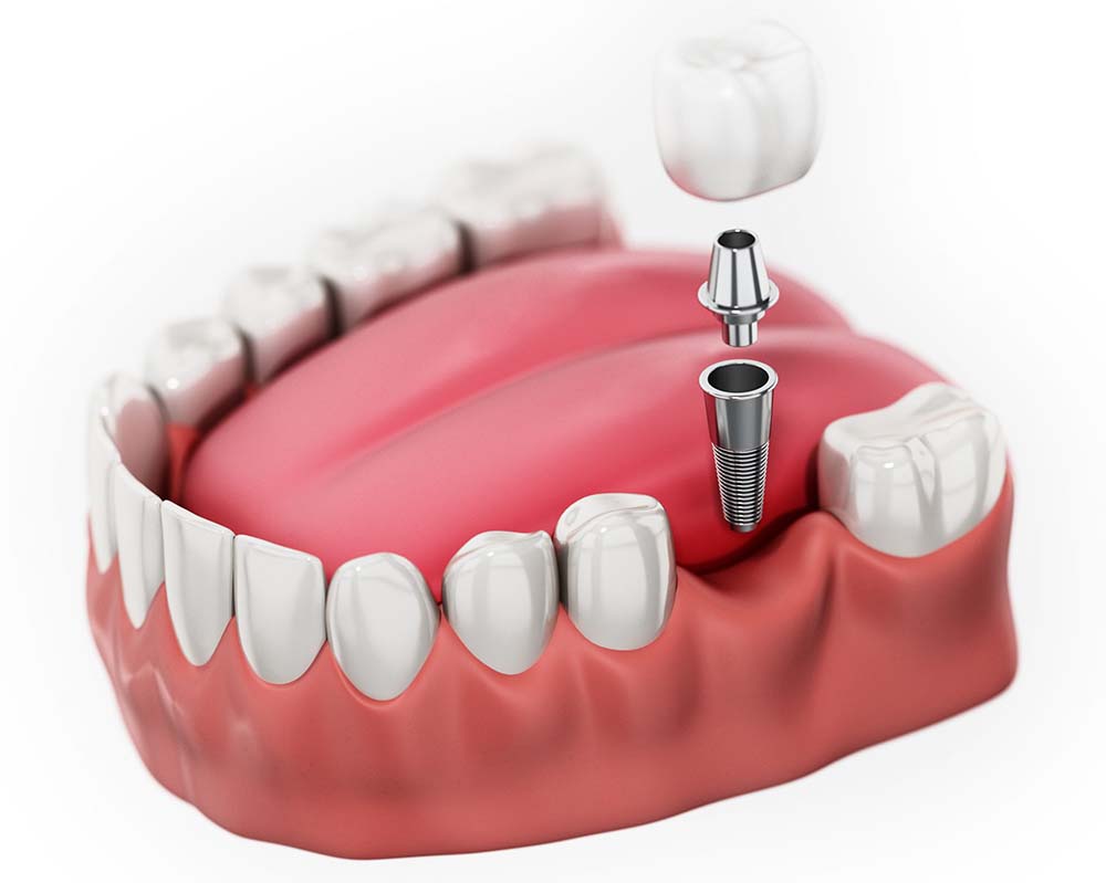 Single Tooth Implant in Kanpur